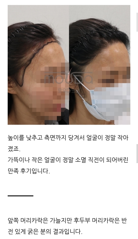 여성헤어라인교정