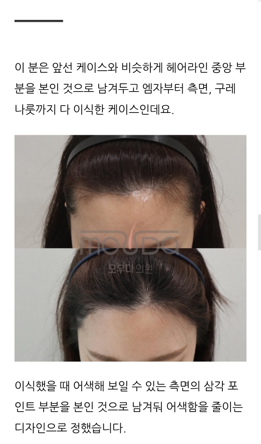 압구정모발이식 모우다의원